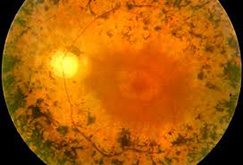 Peripheral retinal degeneration