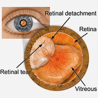Retina Symptoms
