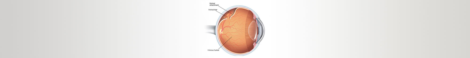 Common Symptoms of Retinal Disorders