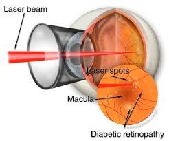 How a laser surgery is performed?
